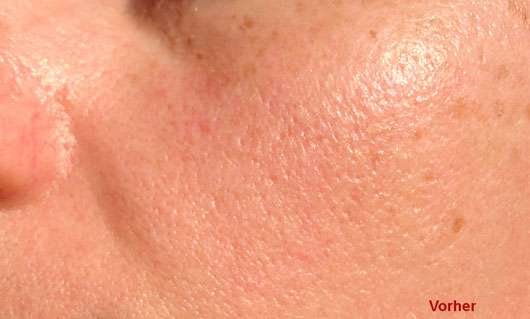 Neutrogena Visibly Clear Teint Correct Hautverschönderndes Peeling