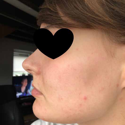 Dr.Jart+ Shake & Shot Rubber Hydro Mask - Haut vor der Anwendung Dr.Jart+ Shake & Shot Rubber Hydro Mask - Haut vor der Anwendung