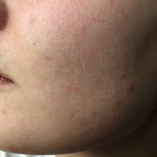 Dr.Jart+ Shake & Shot Rubber Hydro Mask - Haut vor der Anwendung Dr.Jart+ Shake & Shot Rubber Hydro Mask - Haut vor der Anwendung