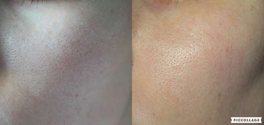 Links: Haut vorher | rechts: Haut nachher