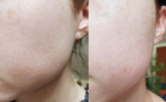 links: Haut vor der Anwendung, rechts: Haut nach 4 Wochen Anwendung