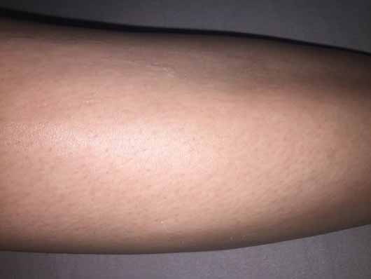 Eucerin pH5 Leichte Textur Lotion - Haut vor dem Test Eucerin pH5 Leichte Textur Lotion - Haut vor dem Test