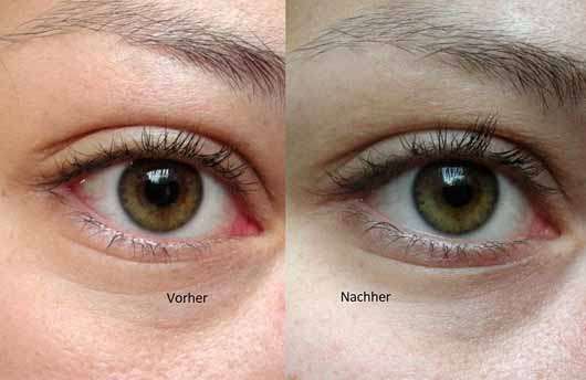 IT Cosmetics Bye Bye Under Eye Concealer, Farbe: Medium (Light-Medium) - Vergleichsbilder Auge