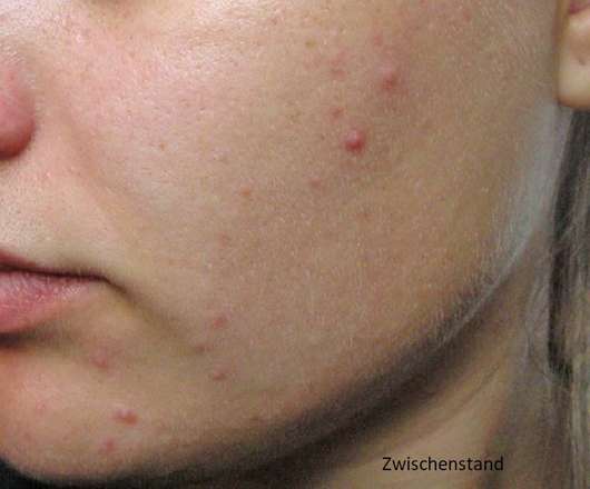Haut während des Test des YOU & OIL Gesichtsöls (Mischhaut)