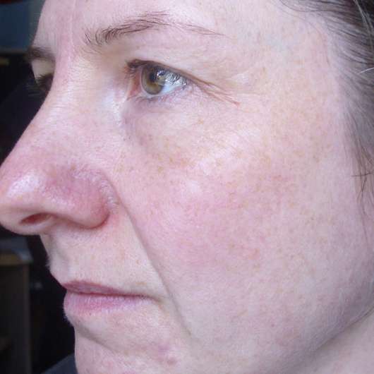 nach der 3. Anwendung - DERMAROLLER Mask nach der 3. Anwendung - DERMAROLLER Mask