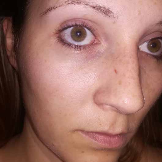 La Roche-Posay EFFACLAR Porenverfeinernde Lotion - Hautbild vor der Anwendung La Roche-Posay EFFACLAR Porenverfeinernde Lotion - Hautbild vor der Anwendung