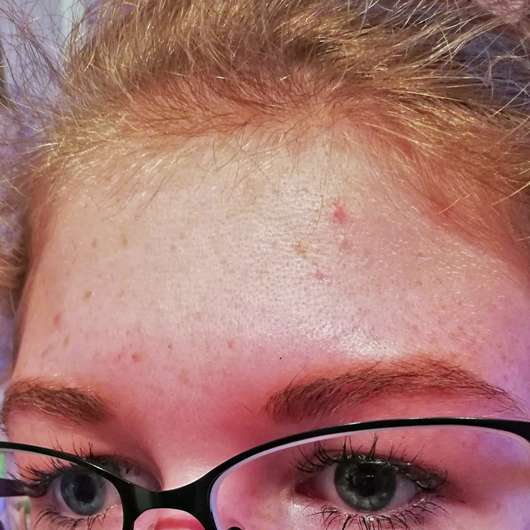 Stirn zu Testbeginn - Eucerin DERMOPURE Gesichts-Tonic Stirn zu Testbeginn - Eucerin DERMOPURE Gesichts-Tonic
