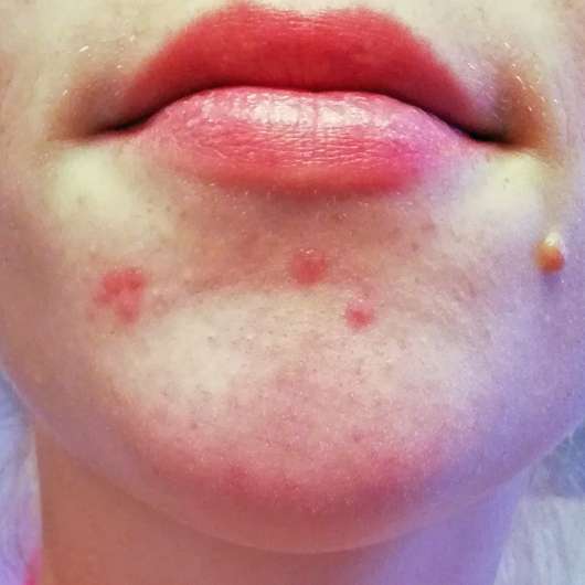 Kinn zu Testbeginn - Eucerin DERMOPURE Gesichts-Tonic Kinn zu Testbeginn - Eucerin DERMOPURE Gesichts-Tonic