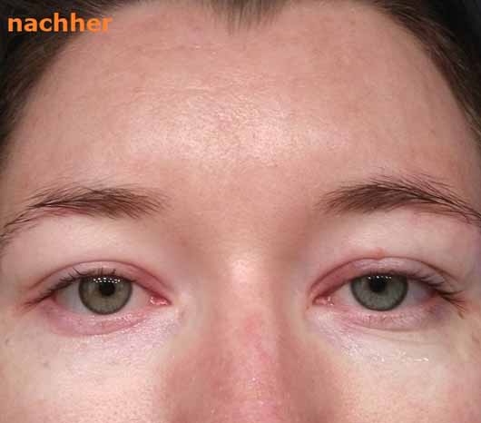 Mlle Agathe Regenerierendes Antiaging-Serum für die Augenpartie - Augenbereich nachher