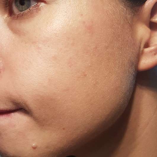 Schaebens Erdbeer Peeling Maske - Haut nach der Anwendung