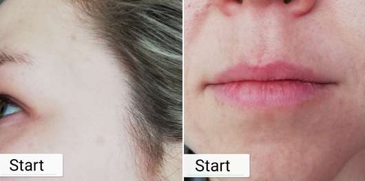 Zu Testbeginn: Pigmentflecken am Haaransatz (links) // Flächen mit Pigmentierung über und unter den Lippen (rechts)