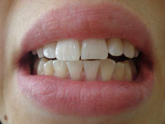 MARA EXPERT Aktivkohle Plus Sensitiv Zahncreme - Zähne nach 4-wöchiger Testphase