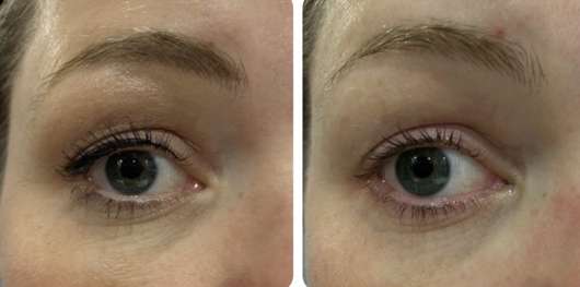 links: Auge vor der Anwendung // rechts: nach der Anwendung links: Auge vor der Anwendung // rechts: nach der Anwendung
