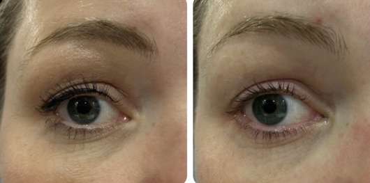 links: Auge vor der Anwendung // rechts: nach der Anwendung