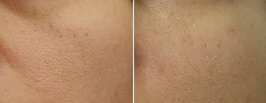 Gertraud Gruber Enzym Peeling Puder - links: Haut zu Testbeginn // rechts: Haut nach 4-wöchigem Test