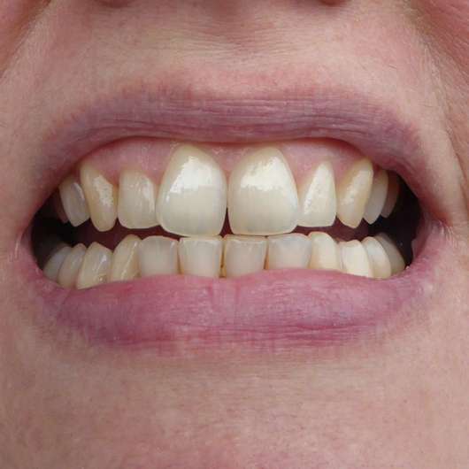 Zähne zu Testbeginn - MARA EXPERT Aktivkohle Plus Sensitiv Zahncreme