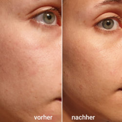 links: Haut vor dem Test, rechts: Haut nach vier Wochen
