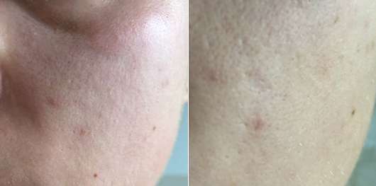 LR ALOE VIA Aloe Vera After Sun Cooling Bomb (LE) - links: Haut zu Testbeginn // rechts: Haut 4-wöchigem Test