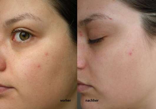 Dr. Scheller Anti-Pickeltupfer gegen Hautunreinheiten - Haut zu Testbeginn // Haut nach 4-wöchigem Test
