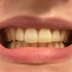 MARA EXPERT Aktivkohle Intensiv Zahnpflege-Jelly - Zähne zu Testbeginn