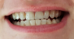 Zähne nach dem 4-wöchigen Test - MARA EXPERT Aktivkohle Intensiv Zahnpflege-Jelly
