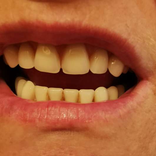 Zähne vor dem Putzen mit der MARA EXPERT Plaque Checker Zahncreme