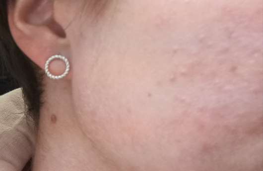 Haut ohne Aknederm Salbe Neu Haut ohne Aknederm Salbe Neu